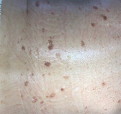 Erase Spots, Bumps, spider Veins, Skin Tags, and More From Face, Neck, Decollete, Back, Hands

$90 preparation and first 15 min of thermolysis, $40 each additional 15 min
 Photo